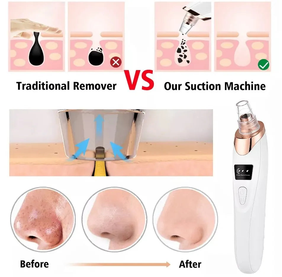 5 In 1 Blackhead Remover Machine Rechargeable